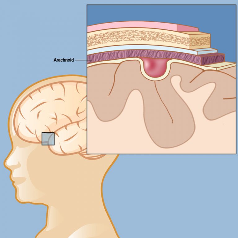 arachnoid-cyst-fetal-health-foundation