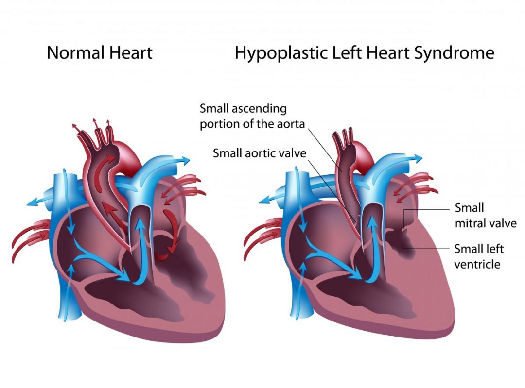 hypoplastic-left-heart-syndrome-fetal-health-foundation