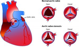 Illustration of a fetal hear and various degrees of aortic stenosis