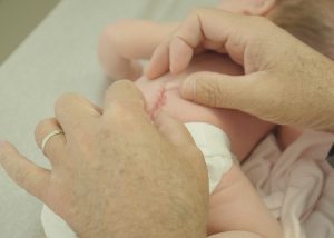 Doctor examines scar at the base of a baby's back following in utero surgery for spina bifida