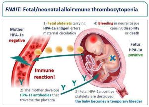 The stages of FNAIT in utero.