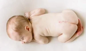 Baby lies on it's belly, unclothed, to show spina bifida repair scar on lumbar spine. 