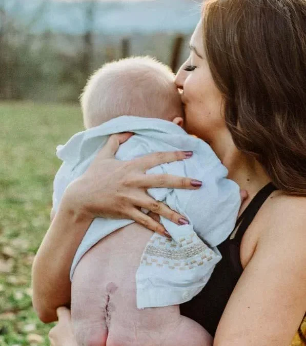 Mom snuggles baby with surgery scar visible at the base of his spine