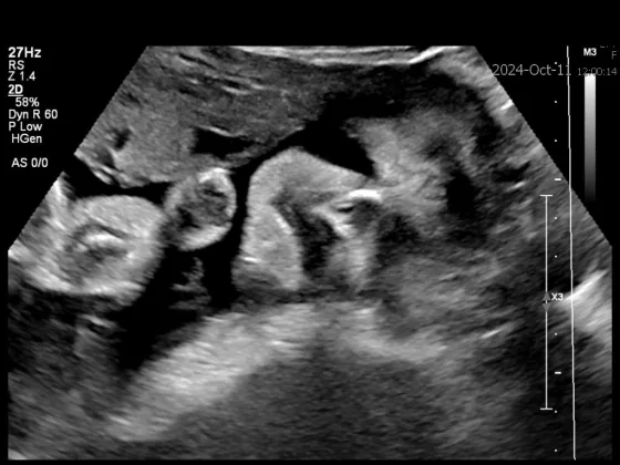 Ultrasound image of baby's face with large dark eye sockets