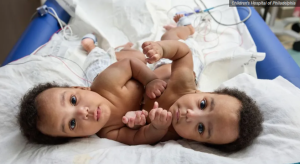 Conjoined twin boys are connected by their abdomen before undergoing separation surgery.