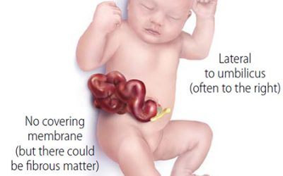 Gastroschisis and the search for better, earlier interventions﻿ at UC Davis Health