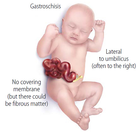 Graphic shows gastroschisis in an infant, with intestines on the outside of the abdomen